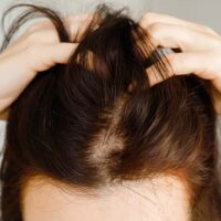 La dermopigmentation capillaire
